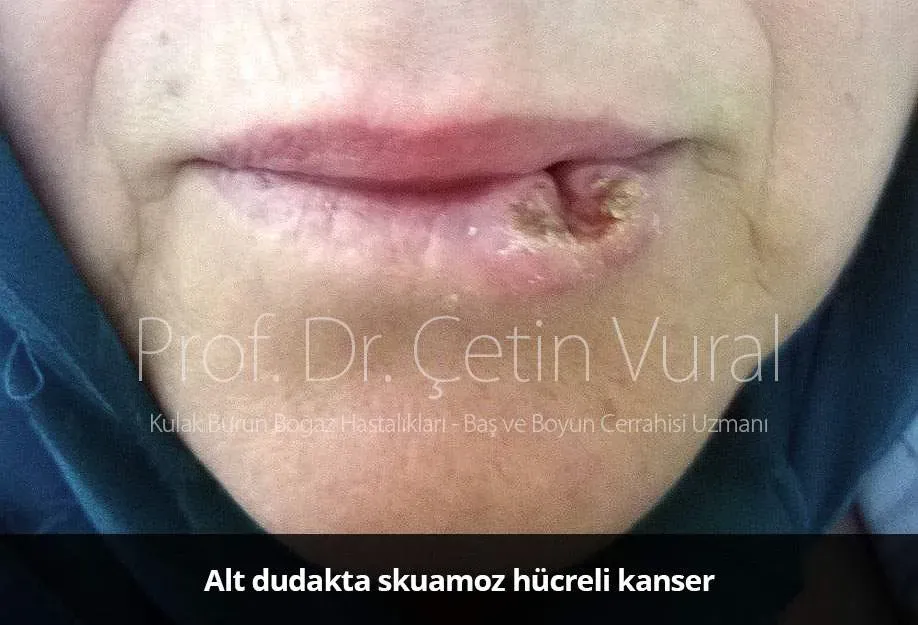 Dudak Kanseriyle Mücadele: Atilla Uçan’ın Sanat Yolculuğu